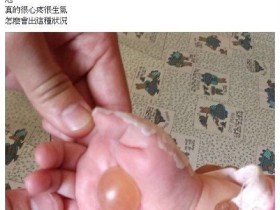女婴看病被医生用手电筒烫起大水泡:为找血管(图)